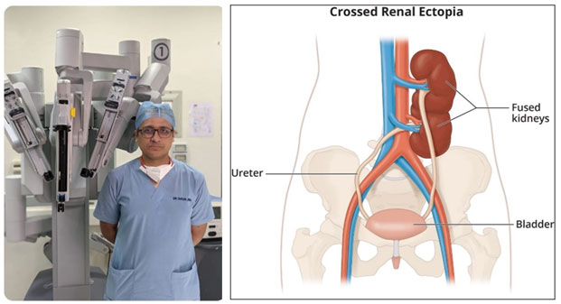 Apollo Cancer Centre Kolkata Performs India’s First-Ever Robotic Surgery for Rare Crossed Fused Ectopic Kidney